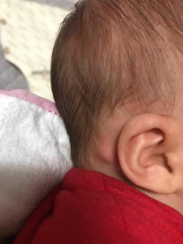 我家宝宝37天,两只耳朵后面各长了一个疙瘩,请