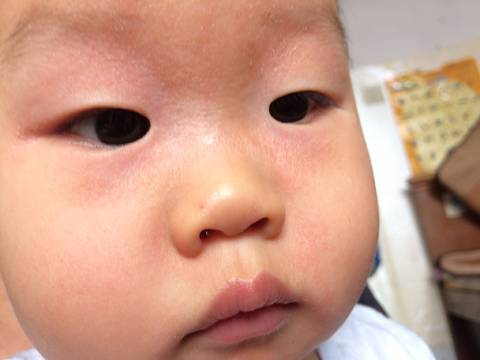 宝宝前段时间眼睛一圈发红褪色,以为吃芒果过