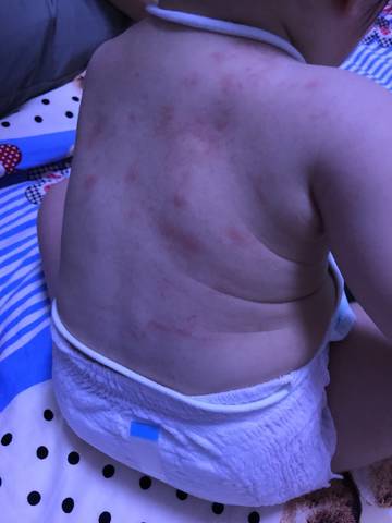 请问宝宝一热身上就起这样的红点,一凉快就消