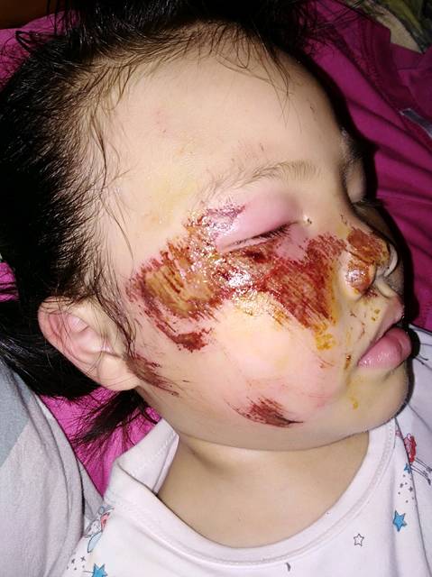 骑车摔倒把孩子脸摔伤了怎么办,有没有办法能