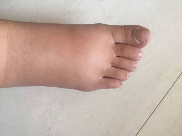 这脚水肿