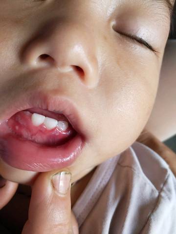 一岁半宝宝牙龈肿痛流口水,用什么药好,到底是