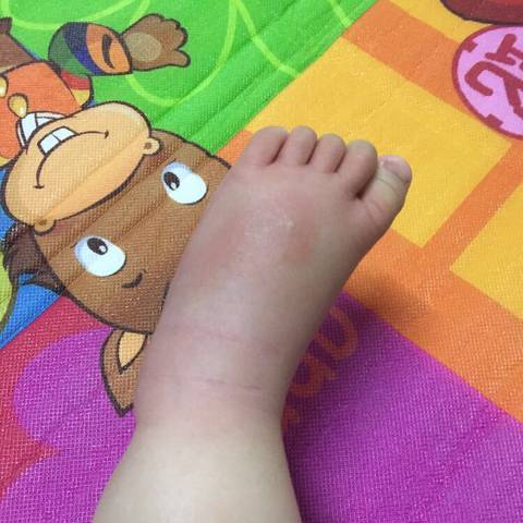 宝宝九个多月脚上昨天早上被咬了,昨晚还只是