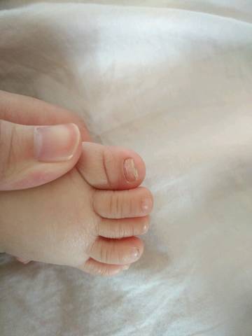 八个月宝宝大脚趾甲变厚往上翘