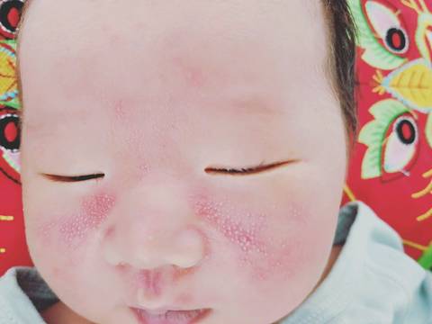 宝宝出生一周,脸上泛红,起一大片带白点点的痘