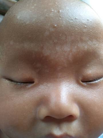 宝宝脑门上眉毛处长一小块小块的白点点是什么