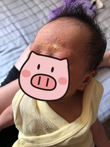 宝宝出生23天,眉毛黄痂,是脂溢性皮炎吗,用面霜