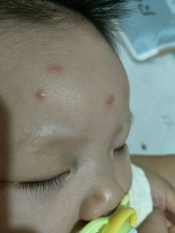 宝宝六个月,大家帮我看看是不是水痘初期症状