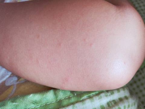 八个月宝宝前几天出疹子 疹子消退后 发现胳膊