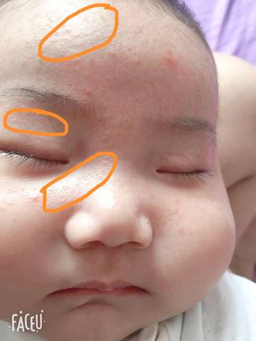 三个月大的宝宝脑门起很多跟皮肤一样颜色的痘