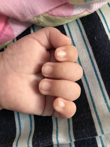 宝宝的这个是杵状指吗