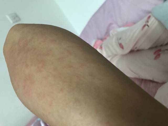 月子第九天、胳膊下面起了好多红点,是湿疹吗