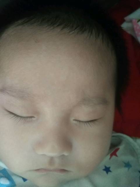 宝宝3个月14天,额头和脖颈有白斑怎么回事?