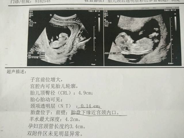 腔位增大。\/宫腔内可见胎儿轮廓\/胎儿顶臀径(C