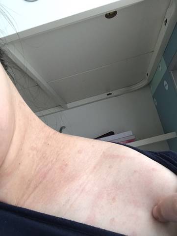 肩部和胸部脖子长了好多小红点_育儿问答_宝宝树