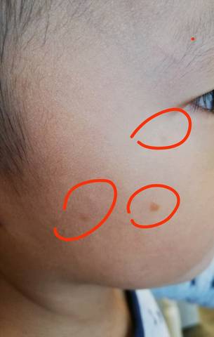 宝宝两岁多,一个月前脸上开始长褐色的一粒粒