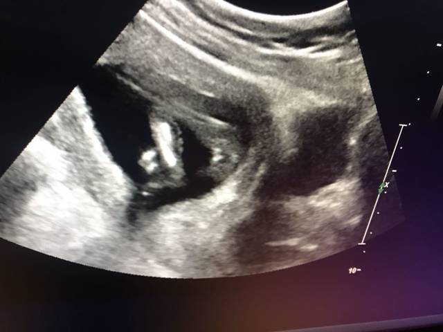 16周已知男宝,附上B超图。孕囊断男女还是挺
