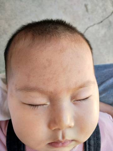 宝宝脸上有咖啡色斑,现在7个月,出生时候没有