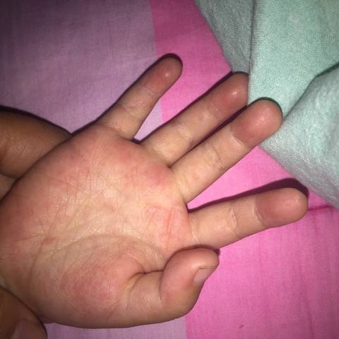 宝宝两岁三个月,手指肚跟手掌发红,有皮下红点,有一个