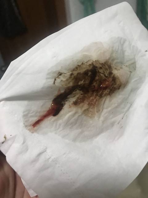 顺产,孩子一定要给力,绕出来,给妈妈一点信心!