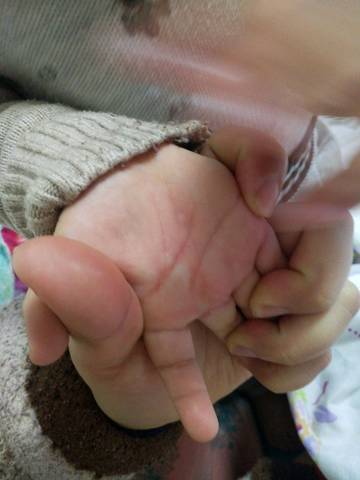 宝宝两周岁,今天发现手掌变成这样,摸着不硬,很痒,小孩老是抓,是冻疮