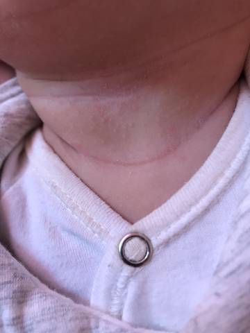 宝2个月,最近脖子上出了好多这个,是淹脖子了
