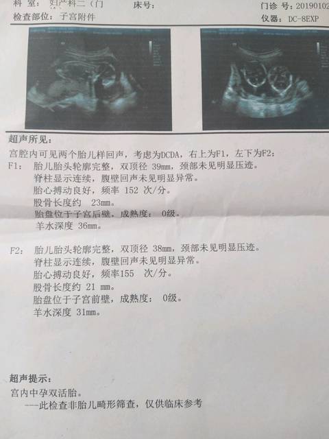 异卵双胞胎看男女