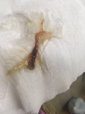 我是34周加1开始出现宫颈粘液分泌物,还有点点红色血丝,立即去医院