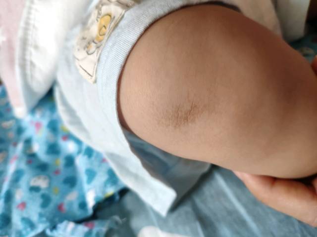 宝宝膝盖有像是色素沉着的黑斑