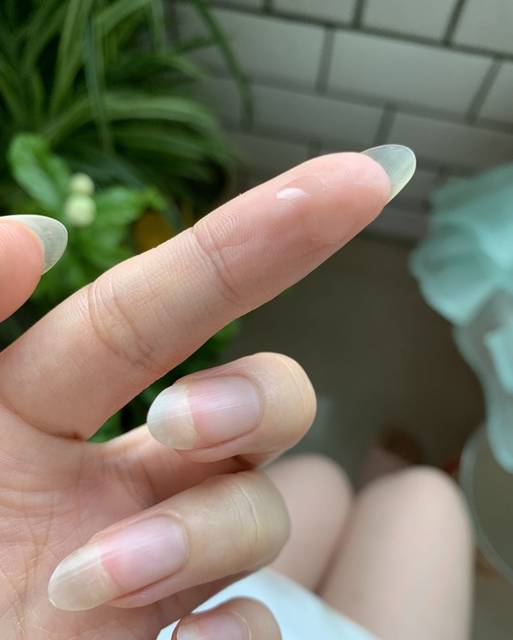 乳头挤出来乳白色的液体,是得了什么病吗