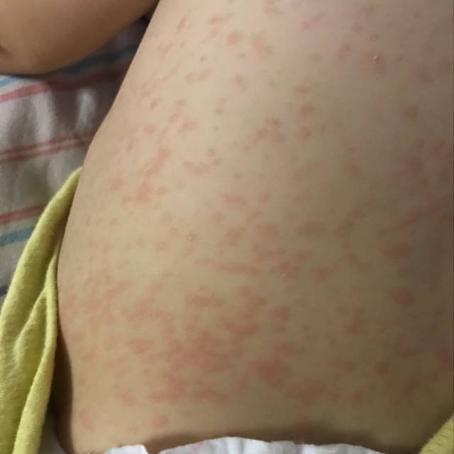 宝妈们请问这是痱子吗. 在线求答谢谢