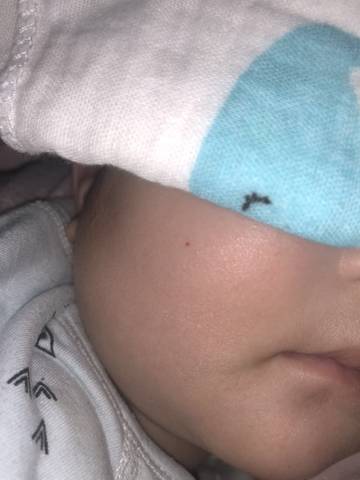 宝宝四个月,突然发现脸上有一个针眼大小的红点,不高于皮肤表面,按压