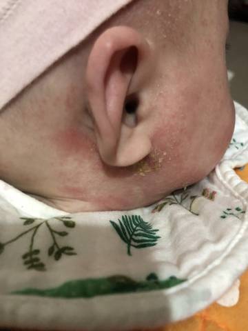 宝宝五个月了吃的奶粉刚开始出湿疹后来耳朵头上开始掉皮而且耳朵烂了