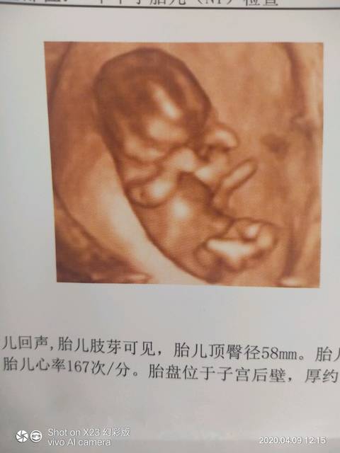 树下 小圈子 宝宝树孕育 孕12周 ,帮忙看看