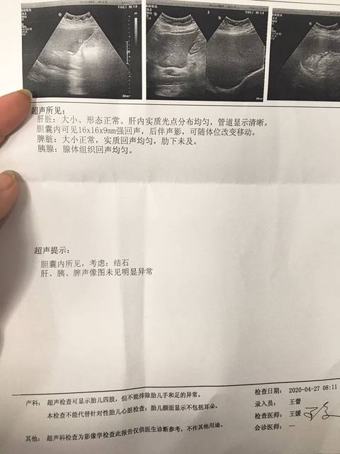 孕妇胆结石要手术吗?
