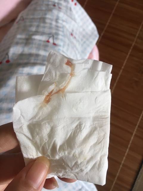 孕期宫颈息肉好烦呐