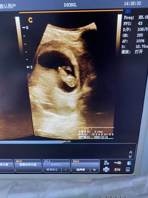 孕10周_孕10周,胎儿发育算正常吗,还看不到胳膊腿的