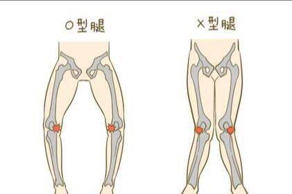 宝宝出现o型腿或x型腿不是穿纸尿裤的缘故真正的"元凶