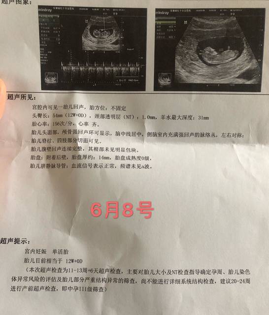 孕12周nt通过啦_今天宝宝很乖,nt10分钟就通过了.医
