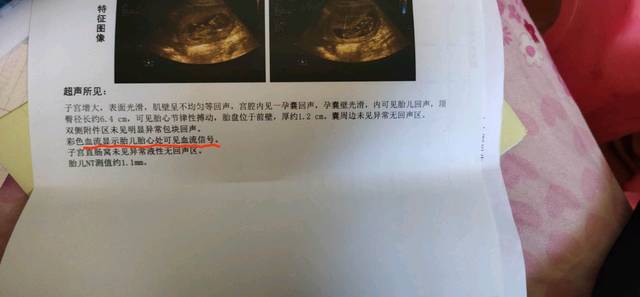 nt 心电图 无创_检查报告结果都拿到了,血流显示胎儿