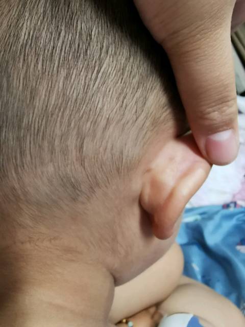 两岁两个月宝宝耳朵后面长了小疙瘩