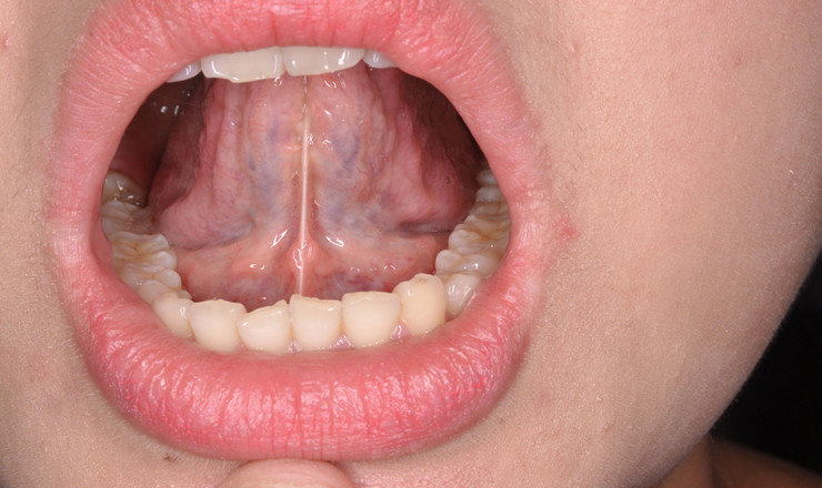 有的家长发现婴儿舌系带比较短,张口时舌尖不能上翘,舌头的活动不