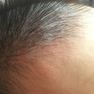 4个月婴儿毛囊炎图片图片