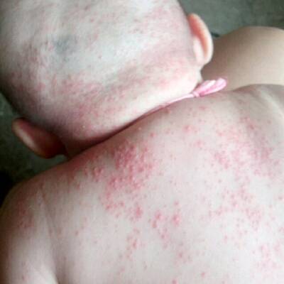 婴儿热疹症状图片图片