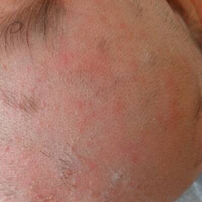 请问这出的是痱子嘛