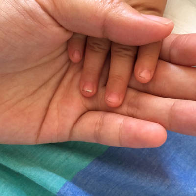 宝宝一岁了,手指甲发白,裏面感觉是空的,是灰指甲吗?该怎麼办?