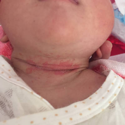 新生儿脖子起红疹子图片