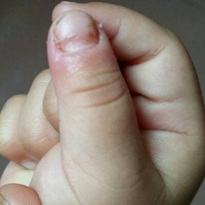 宝宝的大拇指甲周围红红的,指甲还一直掉一点点的出来,还脱皮,这是怎