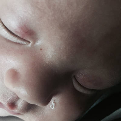 宝宝的额头和眼睛上有红印,能消吗