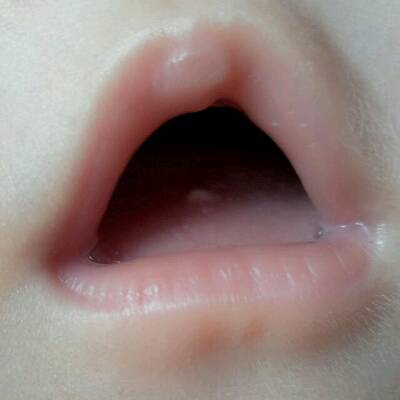 小孩舌头有白点图片图片